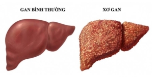 xơ gan