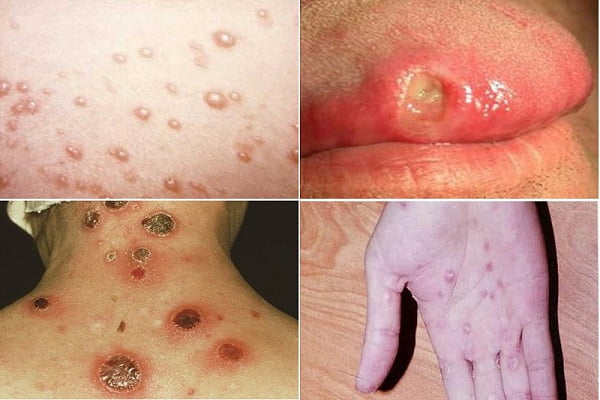 Bệnh giang mai là bệnh lý nhiễm trùng do xoắn khuẩn Treponema Pallidum gây ra