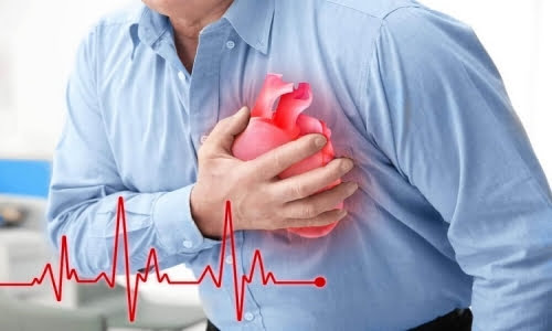 Bệnh giang mai tim mạch gây nên triệu chứng suy tim