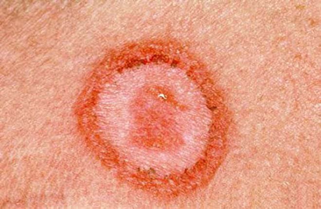 Hình ảnh bệnh giang mai giai đoạn 1 với các vết săng giang mai xuất hiện trên da