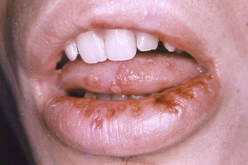 Săng giang mai phát triển ở miệng của người bệnh