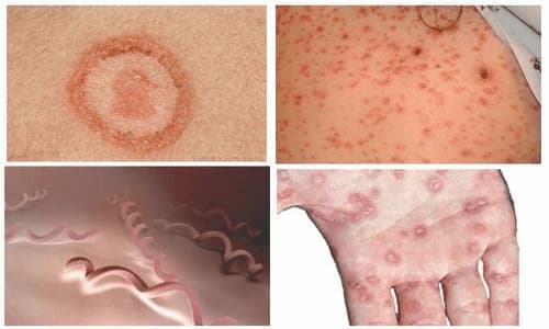 Những biến chứng có thể xảy ra khi bị nhiễm bệnh giang mai hoặc hoa liễu?
