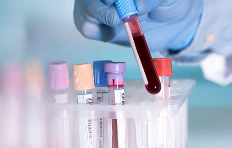 Xét nghiệm máu là cách làm chuẩn xác nhất phát hiện người bị bệnh giang mai