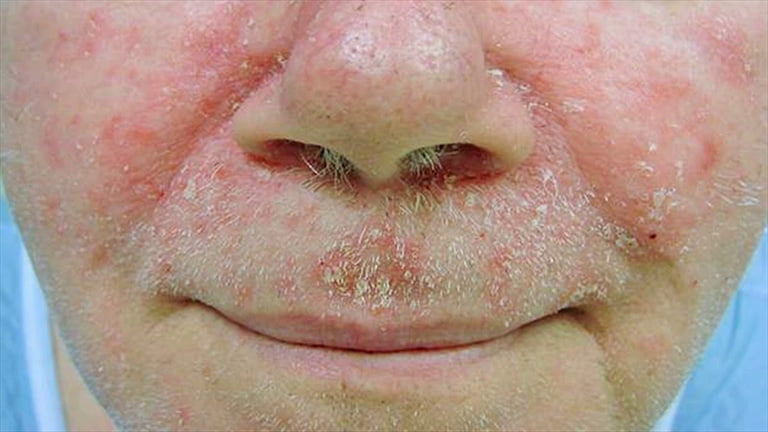 Các nốt phát ban tiến triển nhanh ở bệnh nhân bị giang mai ở mặt