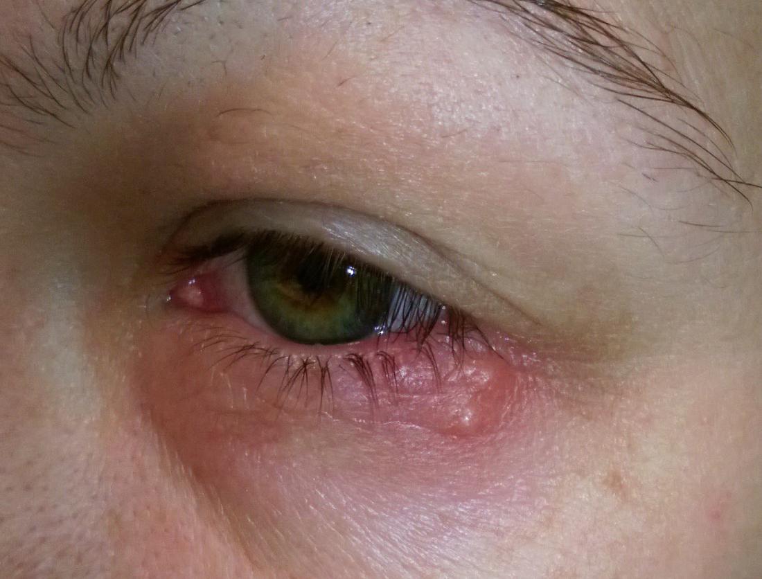 Bệnh giang mai ở mắt và mặt có thể được chữa khỏi hoàn toàn