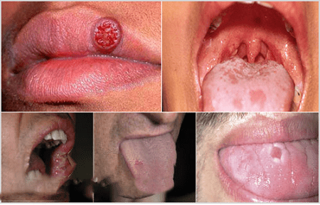 Các nốt săng giang mai nổi khắp khoang miệng của bệnh nhân nhiễm xoắn khuẩn