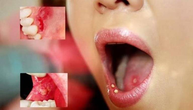 Các vết loét xuất hiện ở cả lợi và nướu răng của người mắc giang mai