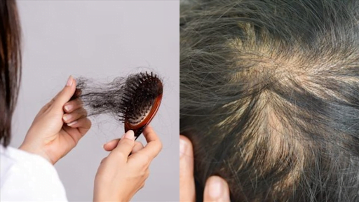 Bệnh giang mai gây rụng tóc tiến triển đến giai đoạn 2