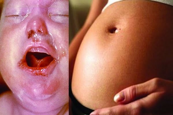 Bệnh giang mai ở phụ nữ dễ khiến thai chết lưu, sảy thai hoặc sinh non