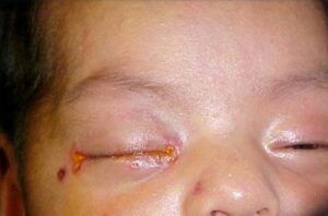 bệnh lậu giai đoạn đầu ở trẻ
