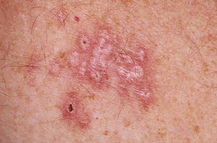 Hình 2: Triệu chứng thường xuất hiện bệnh lậu ở Nam & Nữ 