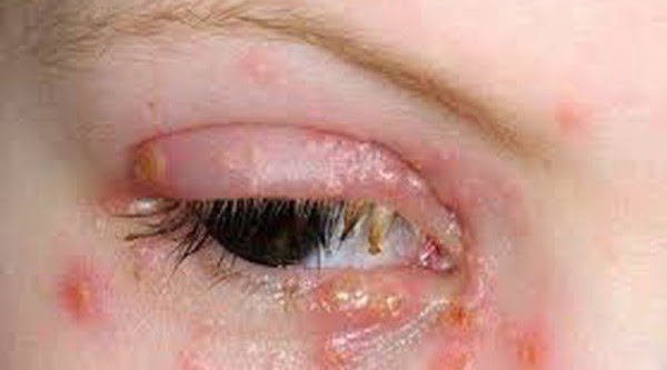 Những nốt đỏ, mưng mủ là dấu hiệu mắc bệnh lậu ở mắt
