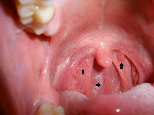 Bệnh lậu ở miệng là gì? Nguyên nhân và cách chữa trị bệnh này ra sao?