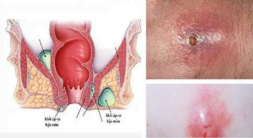 Mủ bệnh lậu ở hậu môn có màu vàng nhạt