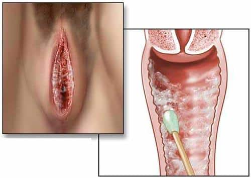 Âm đạo bị viêm nhiễm gây ngứa ngáy ở giai đoạn đầu mắc bệnh lậu