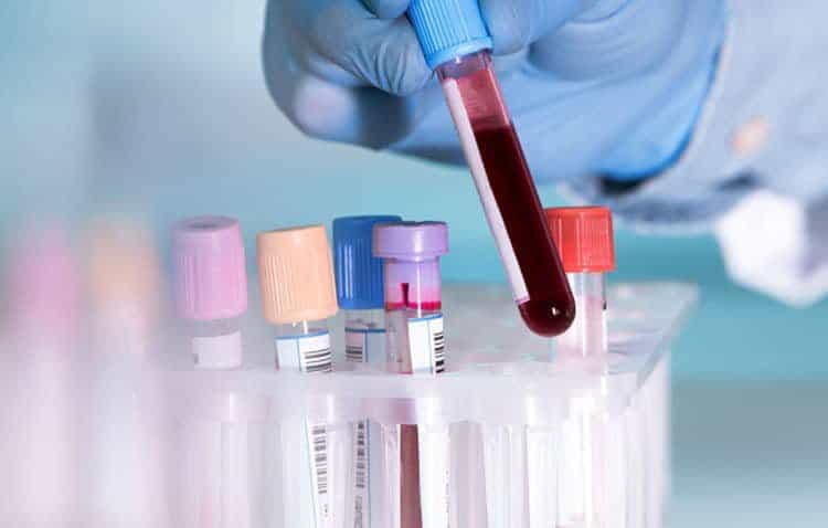 Xét nghiệm PCR giúp phát hiện bệnh lý lậu chính xác hơn que thử bệnh lậu