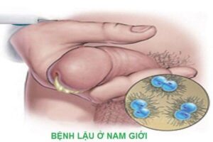 bệnh lậu giai đoạn đầu nam giới