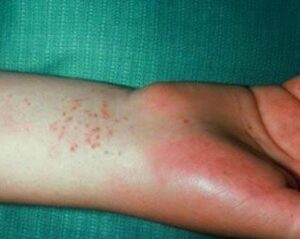 bệnh xã hội Chlamydia
