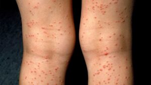 bệnh xã hội hiv
