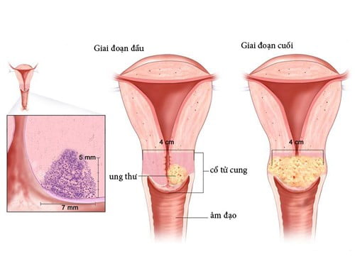 Bệnh sùi mào gà ở nữ giới làm tăng nguy cơ ung thư cổ tử cung