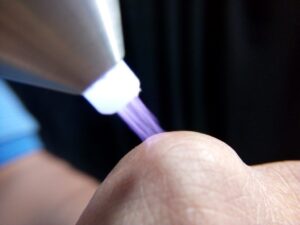 bệnh sùi mào gà phát triển nhanh không