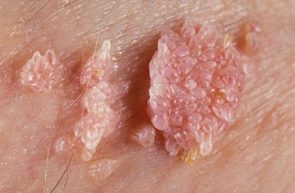 Các nốt đỏ tựa cây súp lơ do vi khuẩn HPV gây nên