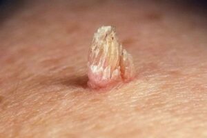 bệnh sùi mào gà phát triển nhanh không