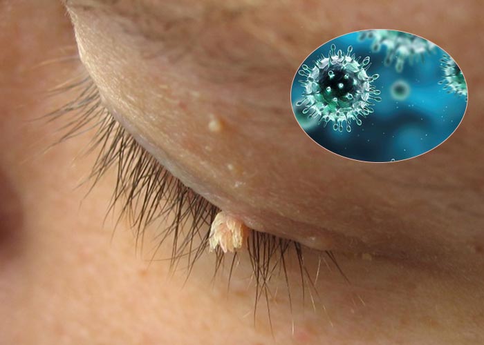 Vì các dấu hiệu tương đối giống với nhiều bệnh lý khác của mắt nên nhiều người bệnh chủ quan hoặc điều trị sai cách dẫn đến bệnh nặng thêm