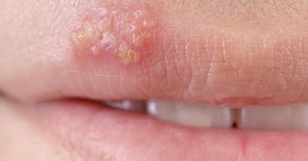 Nấm sinh dục Herpes là bệnh lý truyền nhiễm do virus Herpes gây ra