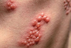 Các nốt mụn rộp xuất hiện trên miệng và vùng kín khi cơ thể bị nhiễm nấm Herpes