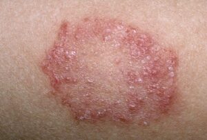 viêm nấm sinh dục