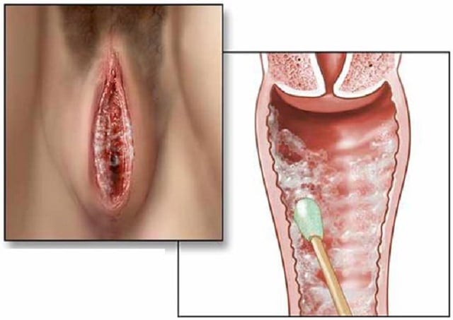 Nguyên nhân và dấu hiệu nhận biết bệnh nấm sinh dục