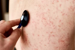 triệu chứng hiv: phát ban