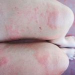 Giang mai sau điều trị có tái phát không?