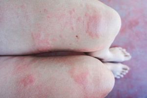 dấu hiệu điển hình của phát ban giang mai