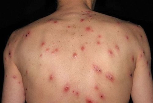 Xử lý khi có săng giang mai