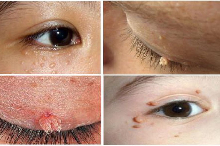 Sùi mào gà ở trẻ nhỏ