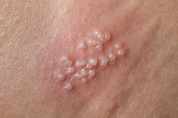 Nguy cơ lậu nếu có nhiều bạn tình