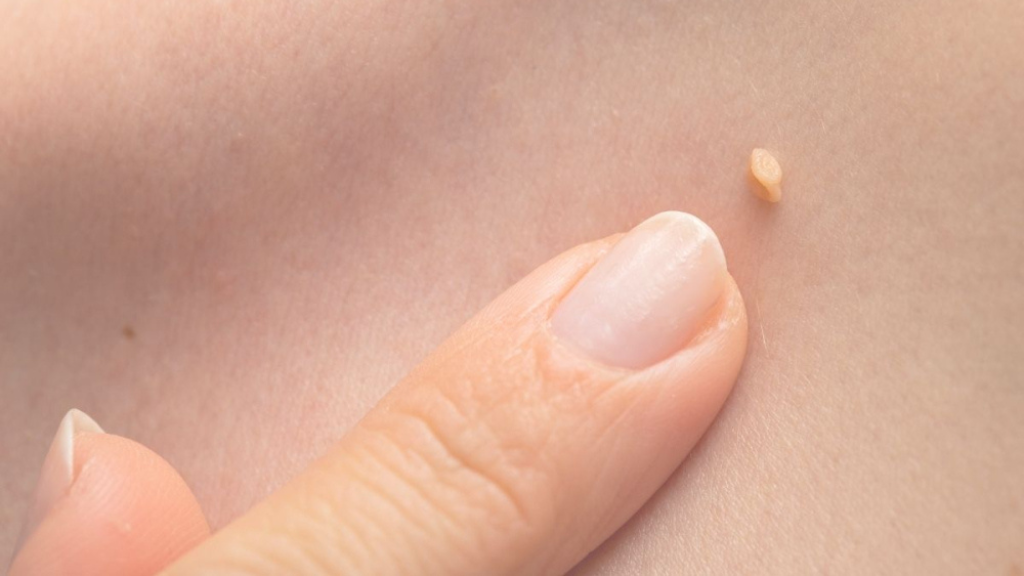 YẾU TỐ NGUY CƠ SÙI MÀO GÀ – NHỮNG AI DỄ MẮC BỆNH?