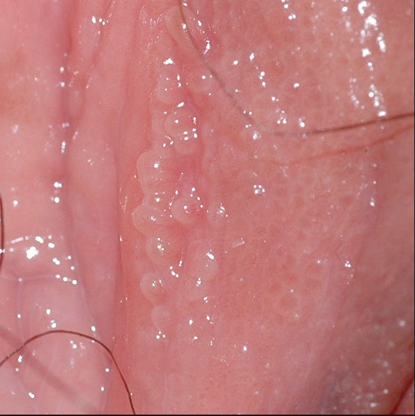 Triệu chứng sùi mào gà ở nữ: nhận biết sớm và điều trị