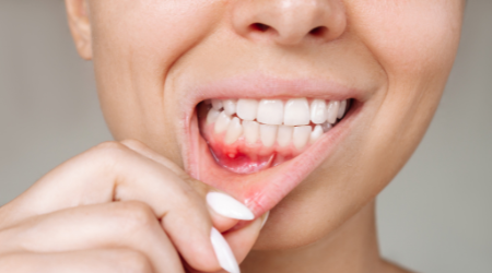 quan hệ tình dục bằng miệng vẫn có nguy cơ