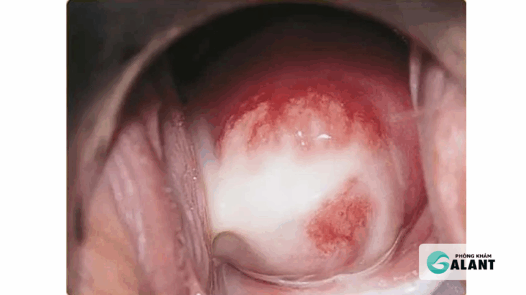 Chlamydia là gì? Bệnh lây truyền qua đường tình dục thường bị bỏ sót