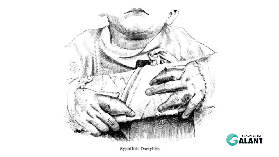 Điều trị Giang Mai Bẩm Sinh (Thông Tin Tham Khảo)