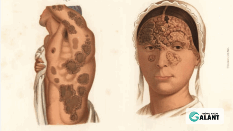 Giang mai có tự khỏi được không