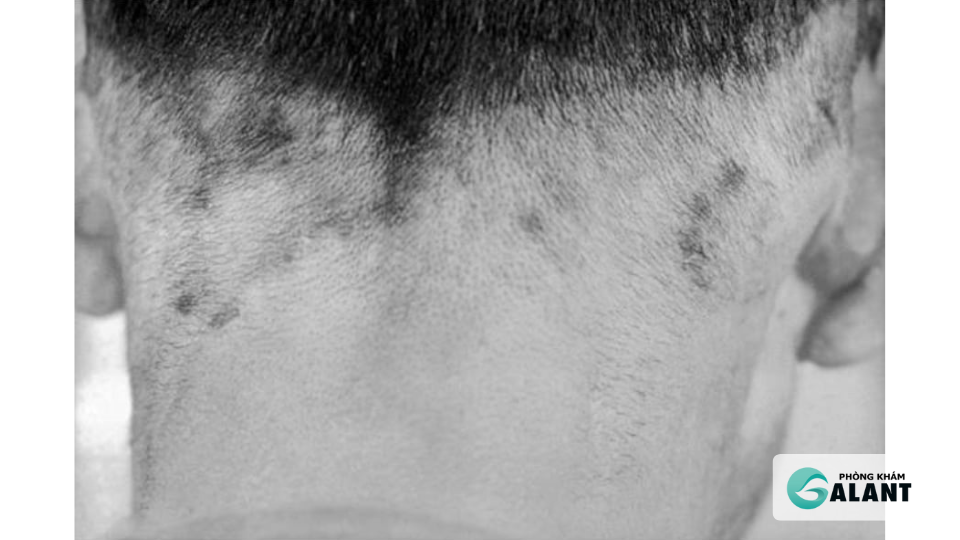 Giang mai thần kinh: dấu hiệu và hậu quả