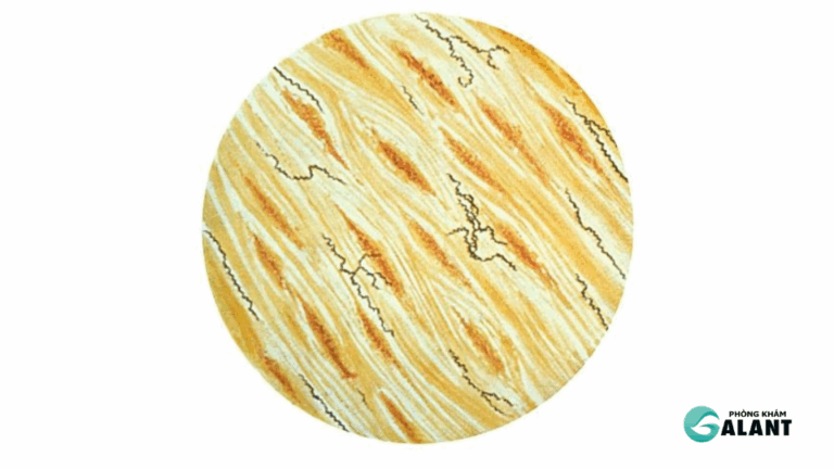 Giang mai giai đoạn tiềm ẩn