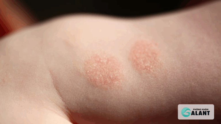 Phát hiện điều trị giang mai sớm, Tráng biến chứng