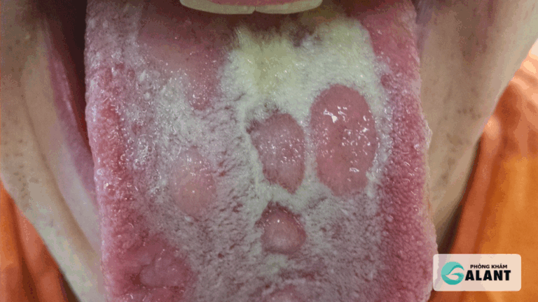 Trường hợp lây giang mai nguy cơ cao