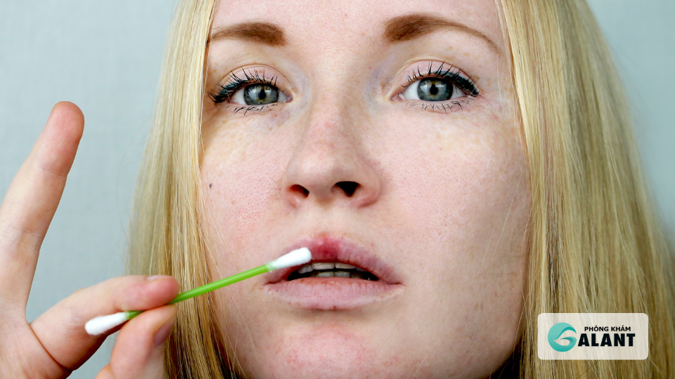 Giang mai lây qua quan hệ miệng: dấu hiệu và phòng tránh