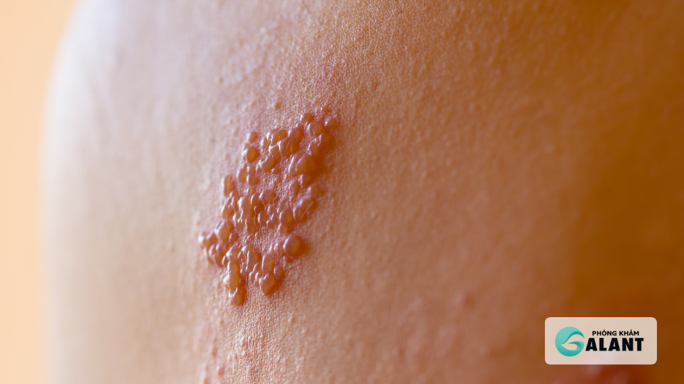 Herpes sinh dục có lây khi không có triệu chứng không?